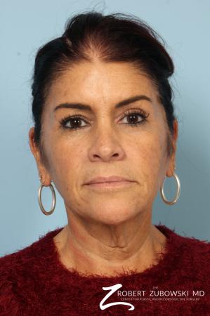 Neck Lift: Patient 10 - Before Image 1