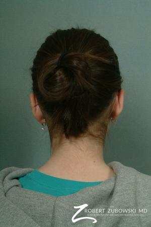 Otoplasty: Patient 6 - After Image 2