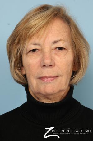 Blepharoplasty: Patient 32 - Before Image 1