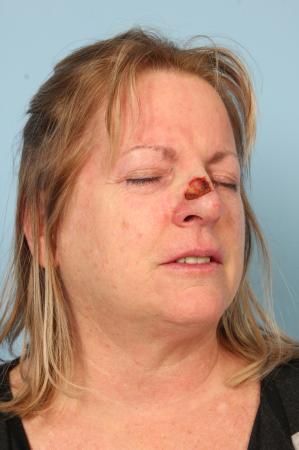 Mohs Closure: Patient 1 - Before Image 1