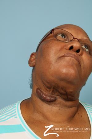Scar Revision: Patient 4 - Before and After Image 2