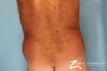 Liposuction: Patient 18 - Before and After Image 3