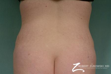 Liposuction: Patient 28 - After Image 1