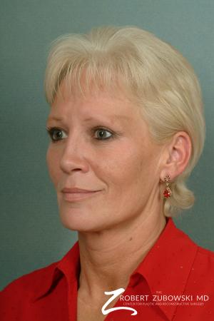 Facelift: Patient 7 - Before and After Image 2