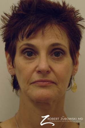 Facelift: Patient 9 - Before Image 1