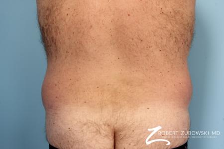 Liposuction: Patient 10 - Before Image 1