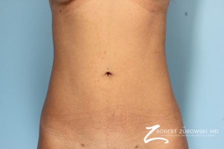 Liposuction: Patient 11 - After Image 1