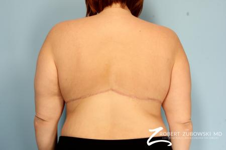 Body Lift: Patient 6 - After Image 1