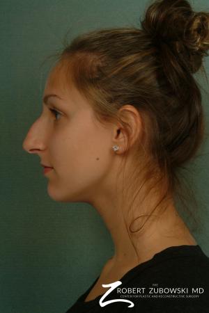 Rhinoplasty: Patient 11 - Before and After Image 2