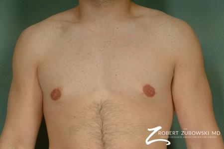 Gynecomastia: Patient 1 - After Image 1