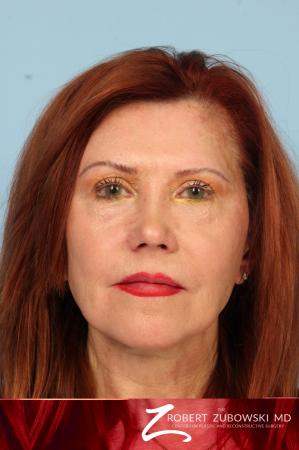 Facelift: Patient 29 - Before Image 1