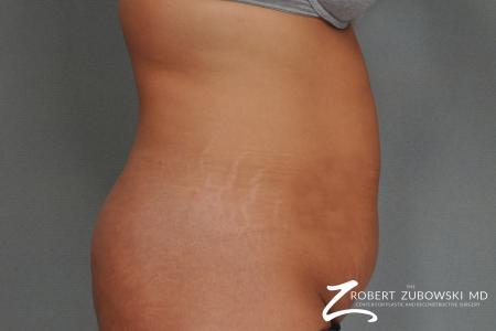 Tummy Tuck: Patient 21 - Before and After Image 2