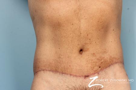 Body Lift: Patient 8 - After Image 1