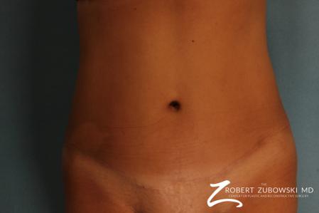 Tummy Tuck: Patient 21 - After Image 1