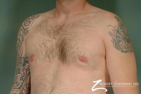 Gynecomastia: Patient 2 - After Image 2