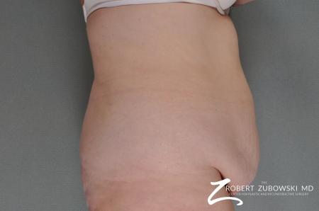 Tummy Tuck: Patient 11 - Before and After Image 2