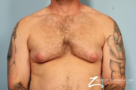 Gynecomastia: Patient 10 - Before Image 1