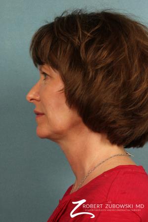 Ultherapy®: Patient 1 - Before and After Image 2