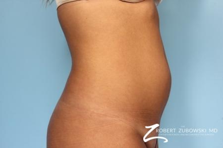 Liposuction: Patient 11 - Before and After Image 2