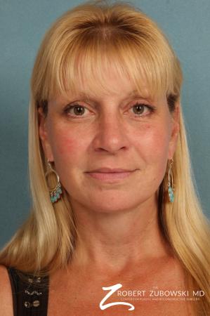 Rhinoplasty: Patient 17 - After Image 1