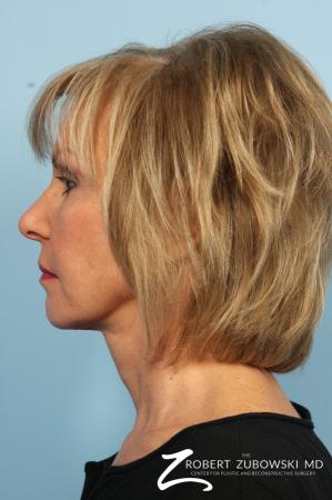 Facelift: Patient 3 - After Image 3