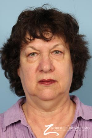 Facelift: Patient 19 - Before Image 1