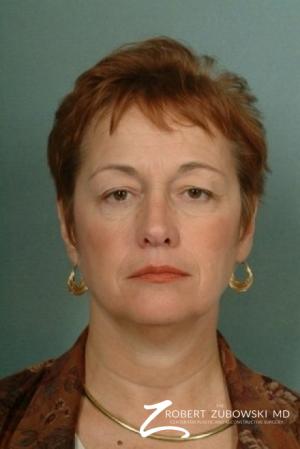 Blepharoplasty: Patient 1 - Before Image 1