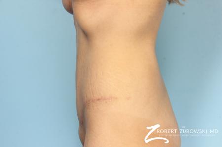 Tummy Tuck: Patient 25 - After Image 2