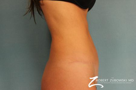 Tummy Tuck: Patient 10 - After Image 2