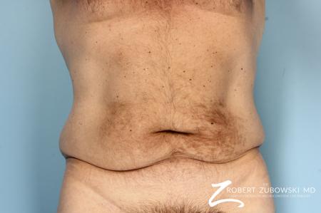 Body Lift: Patient 8 - Before Image 1