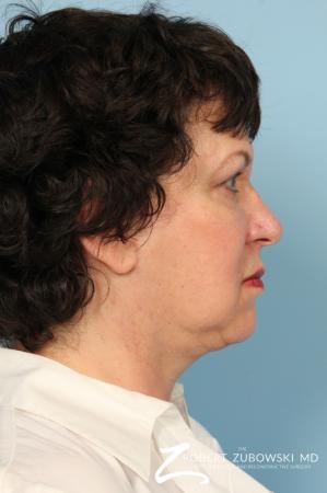 Facelift: Patient 19 - After Image 2
