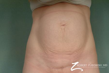 Tummy Tuck: Patient 5 - Before Image 1
