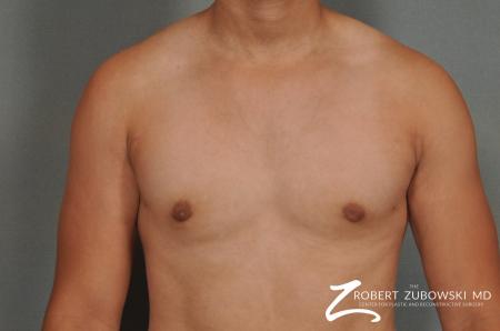 Gynecomastia: Patient 3 - After Image 1