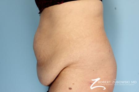 Body Lift: Patient 4 - Before and After Image 2