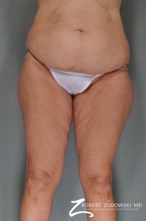 Body Lift: Patient 1 - Before Image 1