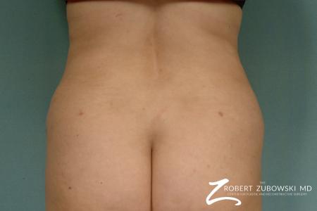 Liposuction: Patient 27 - After Image 1