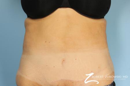 CoolSculpting®: Patient 2 - Before Image 1