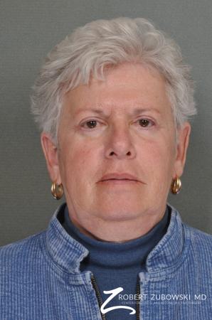 Blepharoplasty: Patient 24 - After Image 1