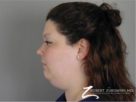 Liposuction: Patient 43 - Before Image 1