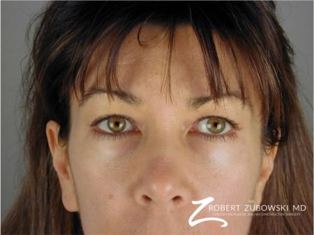 Blepharoplasty: Patient 2 - Before Image 1