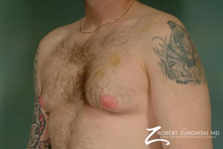 Gynecomastia: Patient 2 - Before and After Image 2