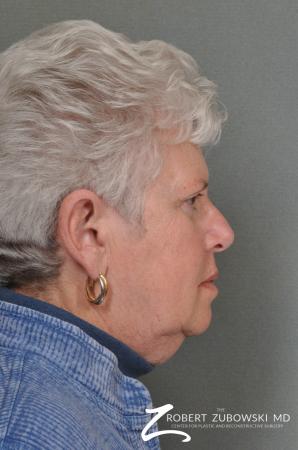 Blepharoplasty: Patient 24 - After Image 2