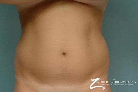 Liposuction: Patient 26 - Before Image 1