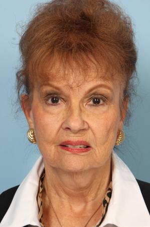 Blepharoplasty: Patient 12 - Before Image 1
