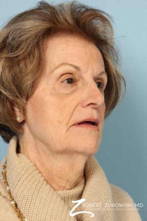 Blepharoplasty: Patient 36 - Before Image 2