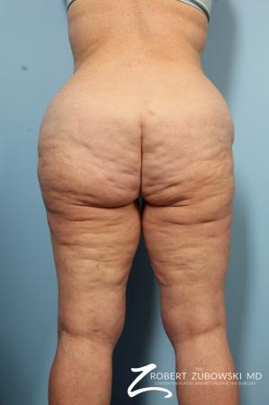 Body Lift: Patient 5 - Before and After Image 2