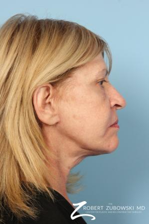 Facelift: Patient 23 - After Image 2