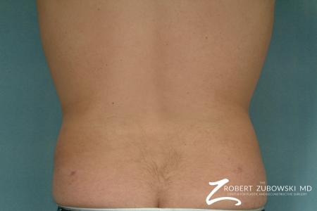 Liposuction: Patient 30 - After Image 2
