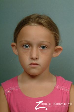 Otoplasty: Patient 1 - Before Image 1
