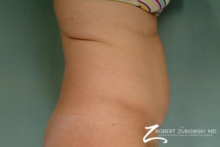 Liposuction: Patient 24 - Before and After Image 3